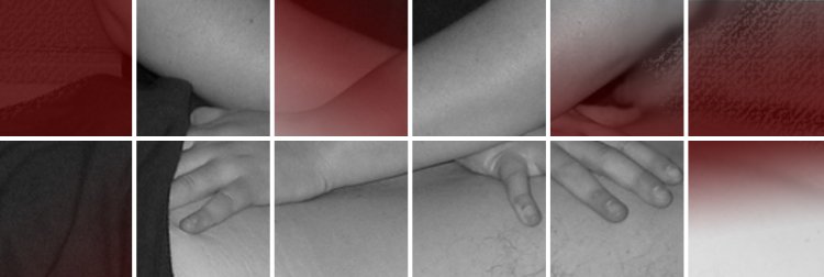 Miofascial_a